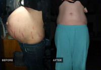 Pregnancy Stretch Marks 1